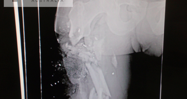 5.56mm_X-Ray_TacMed_Australia